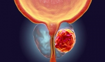 Este ano, 1.740 paraibanos descobriram câncer de próstata e médico afirma que ‘síndrome de super-homem’ dificulta diagnostico precoce