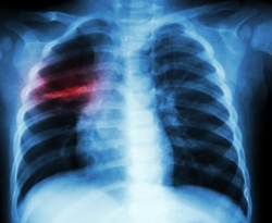 Secretaria da Saúde da PB promove Semana de Combate à Tuberculose