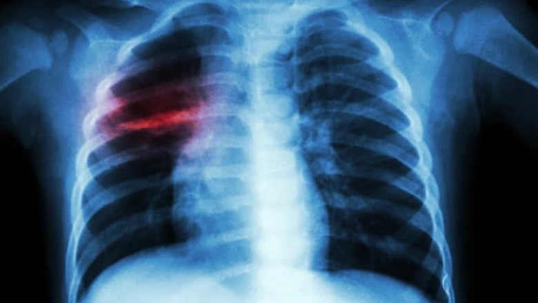 Secretaria da Saúde da PB promove Semana de Combate à Tuberculose