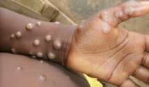Diferente do coronavírus, varíola dos macacos tem difícil transmissão; saiba mais sobre a doença
