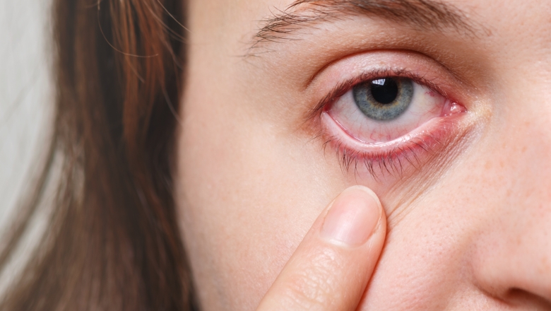 Conjuntivite viral: considerada ‘gripe do olho’, infecção pode levar à cirurgia