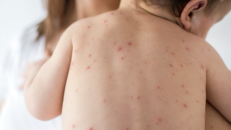 Vacinação contra sarampo inicia segunda-feira para crianças menores de 5 anos 