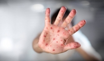 Saúde alerta a população para atualização da vacina contra o sarampo 